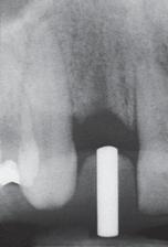 singleimplant supported restoration was indicated.