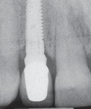 mount in place, an implant-level index impression was taken.