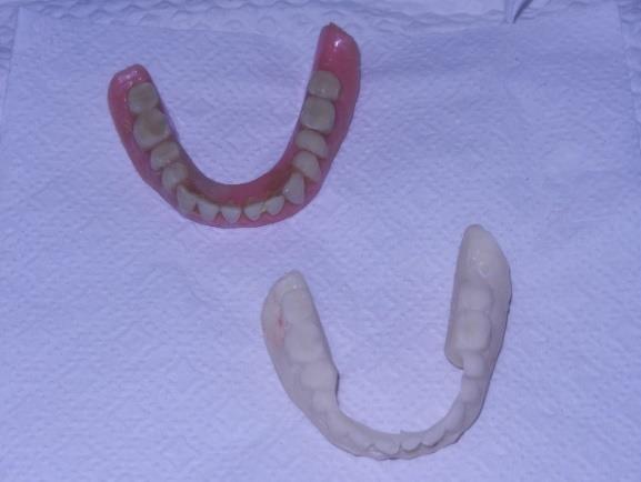 5 Duplicate denture