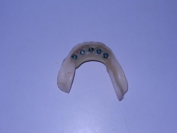 lower denture Figure