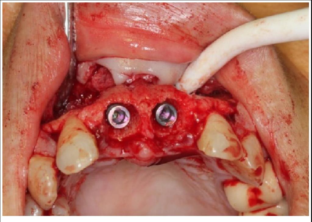 implants (Figure 9). Two weeks later, took dental impression.
