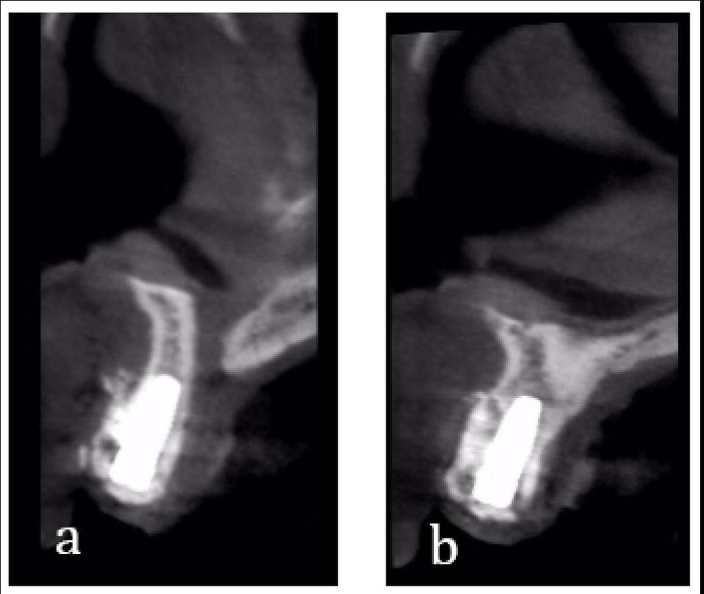 (Figure 10), and bonded ceramic crowns (Figure 11).