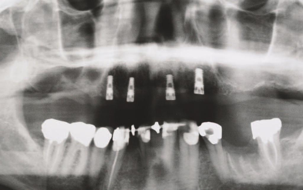 Following approximately 4 months of healing, the implants were exposed. Figure 21.