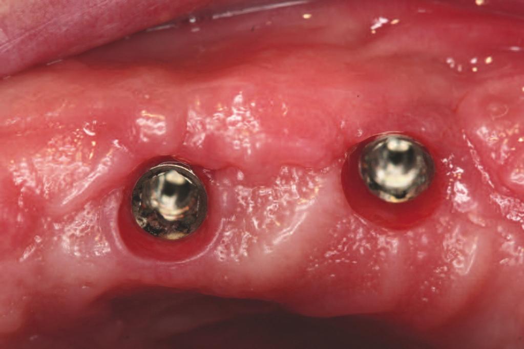 The underside of the palateless (horseshoe-shaped) implant-retained ovedenture holds the female portions of the LOCATOR