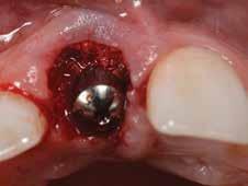 It was placed in the peri-implant tissues to support them in its pre-extraction state and then joined with the implant screw-retained abutment post. Fig 10.