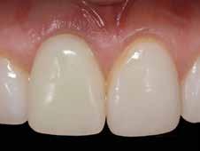 The bone and soft tissues matured around the implant and provisional restoration; at 5 months healing the gingival tissues showed excellent shape and fullness (Figure 14).