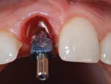 Through proper implant positioning and restorative subgingival contour, the recession defect was corrected. Fig 16.