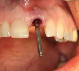 proper positioning of the implant site.