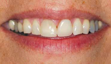 For esthetics, the maxillary right central incisor crown would be replaced following preparation.