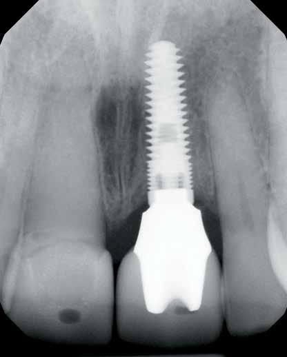 Figure 24: Final periapical radiograph of the implant abutment and crown in place exhibits the natural emergence profile of the final restoration.
