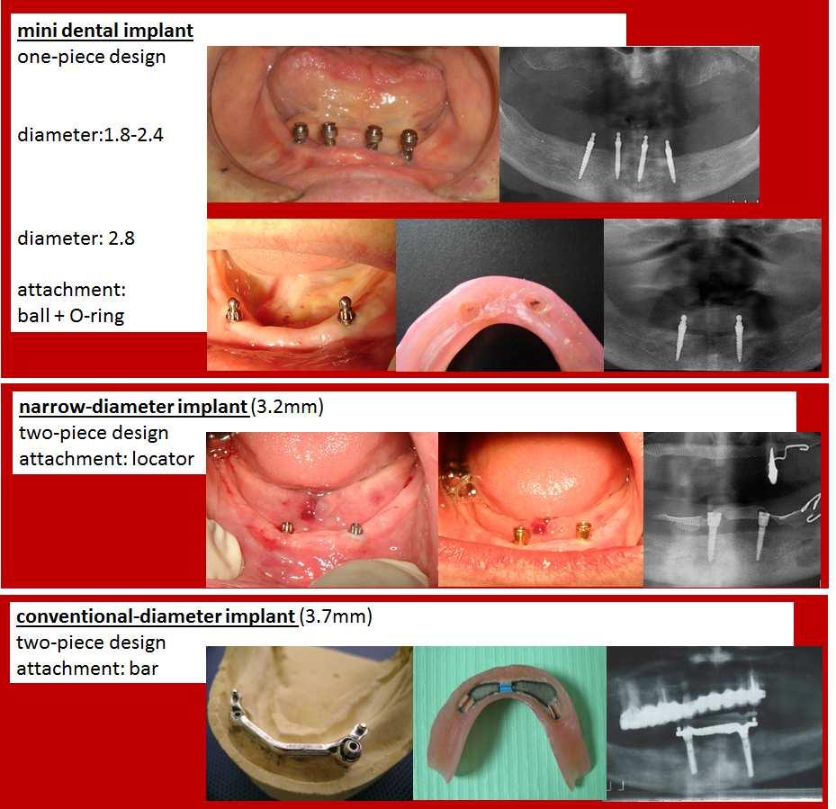90 Current Concepts in Dental Implantology Figure 8.