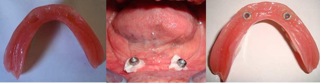 Minimally Invasive Implant Treatment Alternatives for the Edentulous Patient Fast & Fixed http://dx.doi.org/10.