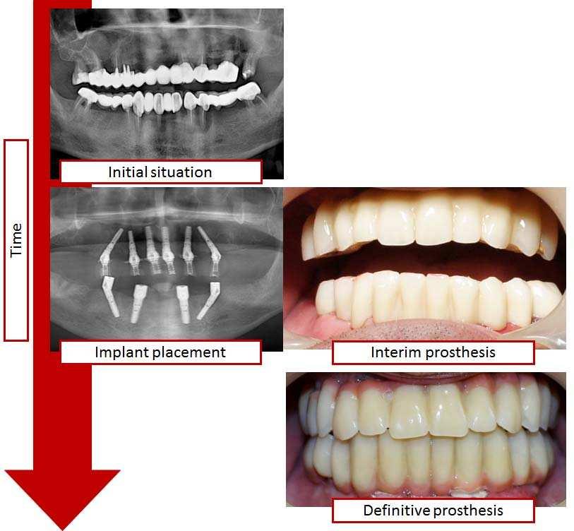 80 Current Concepts in Dental Implantology Time sequence of the main phases of Sky Fast & Fixed can be observed in figure 1. Figure 1.