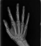 4 EDI Fig. 8 The hand X-ray shows a discrete demarcation of the radius and ulna epiphyses. No lateral notches. Fig. 9 Free subepithelial connectivetissue graft, made to overlap a few times.