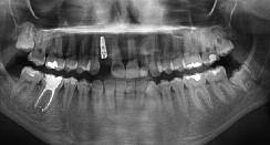 6 EDI Fig. 19 Successful endodontic therapy of tooth 46 (Dr Bakarčić, Dental clinic Rident). Fig. 20 The final photo. The patient looks less like a young girl and more like a young woman.