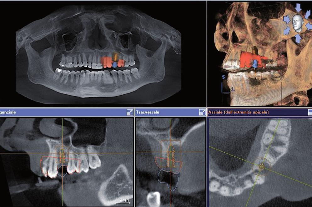 Dr. Giancarlo Romagnuolo Roma, Italy From planning to surgery: a totally digital working flow for Leone implants placement Keywords guided surgery, 3D implant planning, single missing tooth, delayed