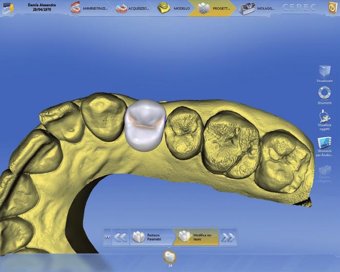 4), then designed the virtual diagnostic denture (figs. 5, 6), made the intra-oral radiographic evaluation (fig. 7) and the TC Cone Beam exam (fig.