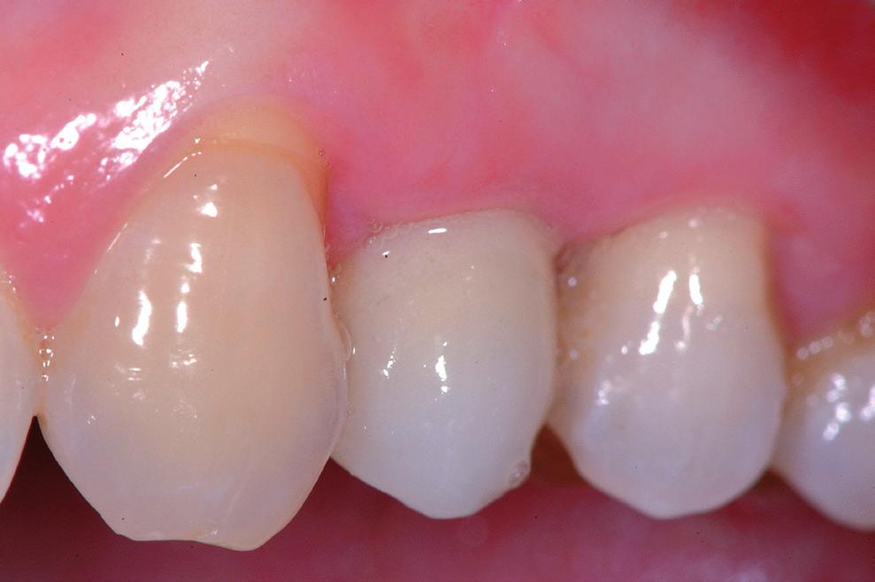 A resin-made provisional crown was fabricated directly