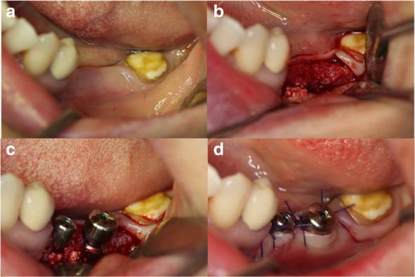 Kim et al. Maxillofacial Plastic and Reconstructive Surgery (2016) 38:41 Page 4 of 6 Fig. 2 Intraoral photographs of the bone graft site at the time of implant placement (one-stage procedure).
