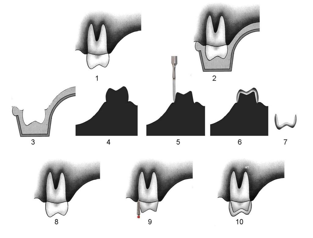 the thickness of future artificial crown) imitation of tooth preparation in clinic is performed (fig. 4.5). After cutting of teeth on stone model, the denture construction is modelled from wax (fig.