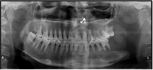 left mandibular ramus region Figure 5 - Coronal
