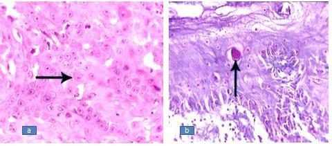 Fig.2 Individual cell Keratin pearl staining in oral squamous cell carcinoma by H&E (a) and Modified Mallory s (b) stain. The better differentiated oral SCC has a better prognosis.