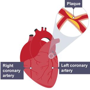 Coronary Heart Disease The coronary arteries supply blood to the heart muscle. These may become blocked by a buildup of fatty plaque containing cholesterol.