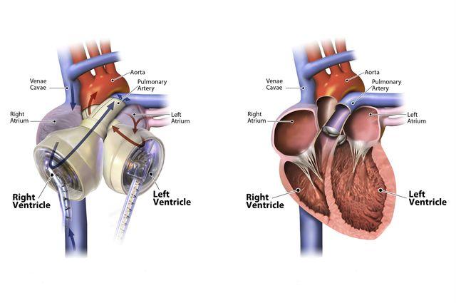 Artificial Hearts Mechanical device that is implanted to help or replace a failing heart by adding an extra ventricle to help pump blood