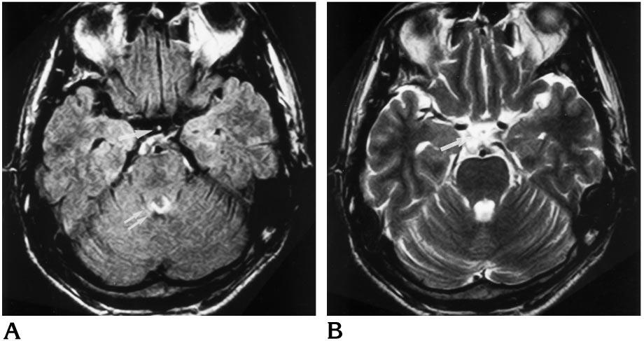 A 25-year-old woman with diabetes insipidus. A, Axial FLAIR MR image of the brain (obtained on a 1.