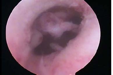 Figure 6: Hysteroscopic view of