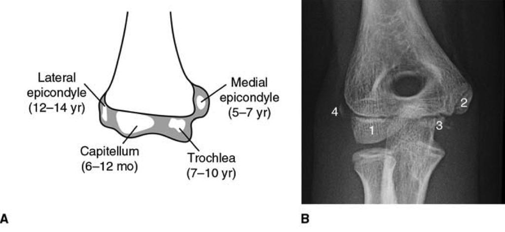 MEDIAL EPICONDYLE FRACTURES Demographic 20% of elbow fractures 60% of which are associated with elbow dislocation.