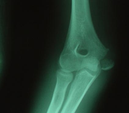 center to fuse to the distal humerus 4. It serves as the anatomic origin for the flexor-pronator mass 5.