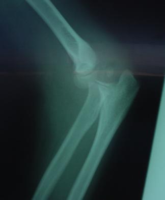 Valgus stress on the elbow joint while falling on an outstretched hand Classification [Papavasiliou] Type 1 Undisplaced avulsion of the epicondyle Type 2 Avulsed at