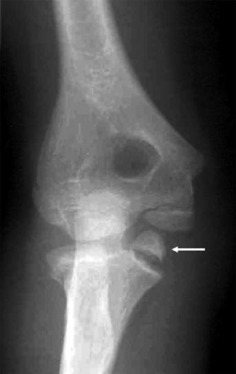 children should be to achieve bony union. Growth is not interfered with use of the screw. Incarcerated Medial epicondyle.