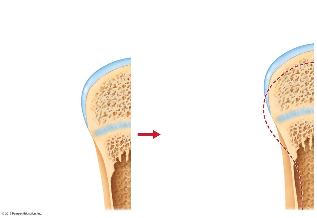 Bone growth Bone grows in length because: 1 Cartilage grows here. 2 Cartilage is replaced by bone here. 3 Cartilage grows here. 4 Cartilage is replaced by bone here.