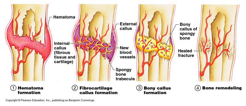 Stages in the Healing of a Bone Fracture Figure 5.