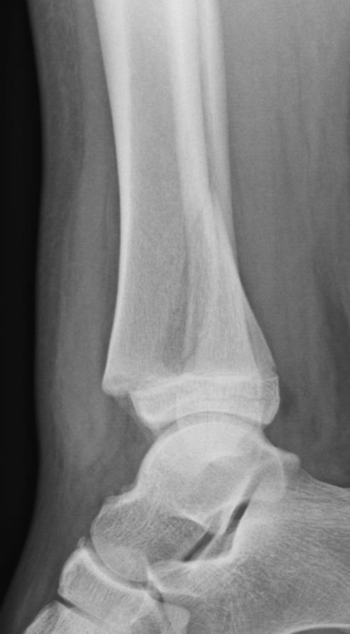 Physeal Fractures 15-30% of all childhood