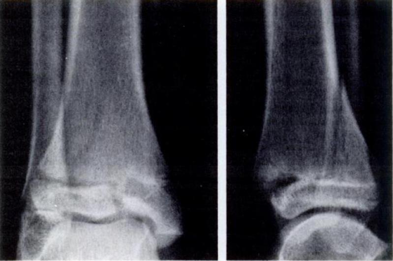 Signs of two part Medial malleolus continuous with