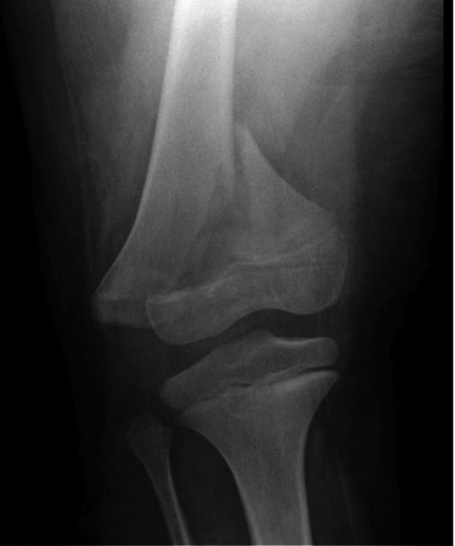 Physeal Injuries 1-10% of physeal fractures with growth disturbance Most in