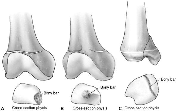 Angular deformity Joint
