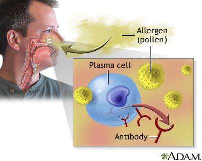 Allergic Rhinitis Rhinitis: Symptomatic disorder of the nose characterized by itching, nasal discharge, sneezing and nasal airway obstruction.