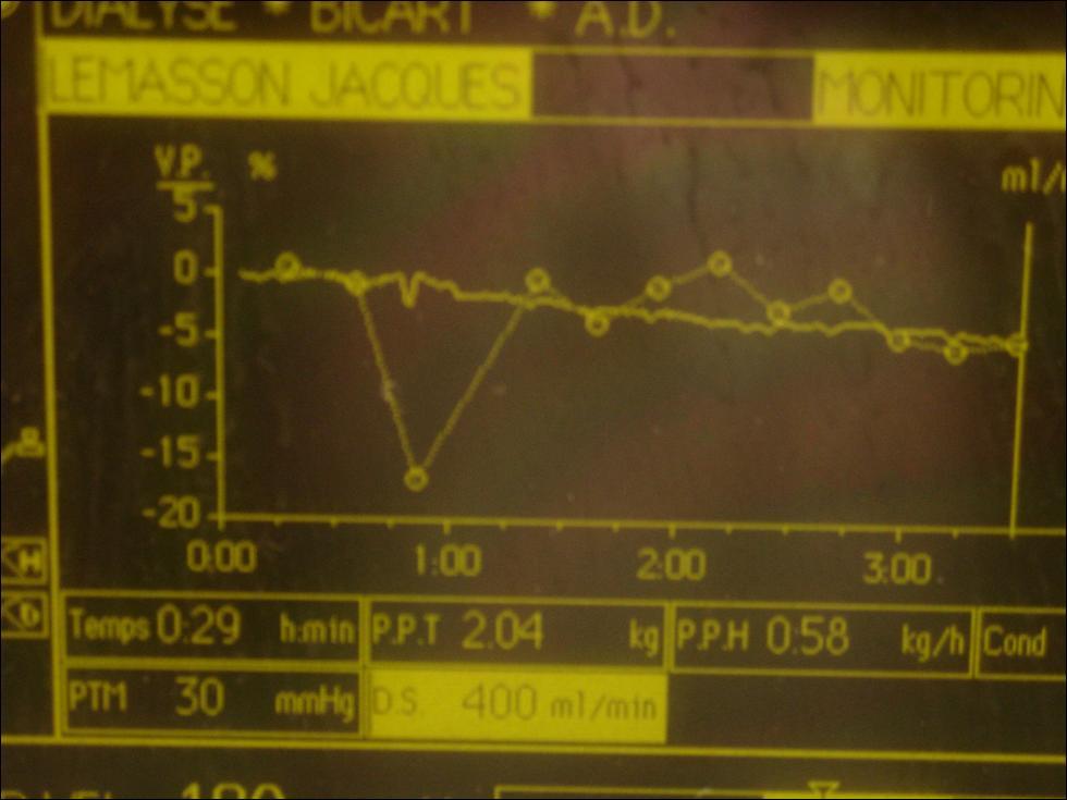 Qa measurement (ionic dialysance) Diascan / OCM devices Dn=200 Inversion lignes