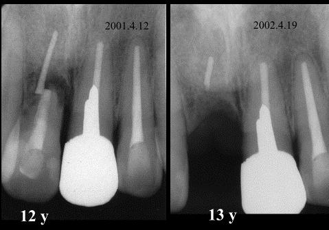 Unsuccessful endodontic treatment result in periapical lesion of the
