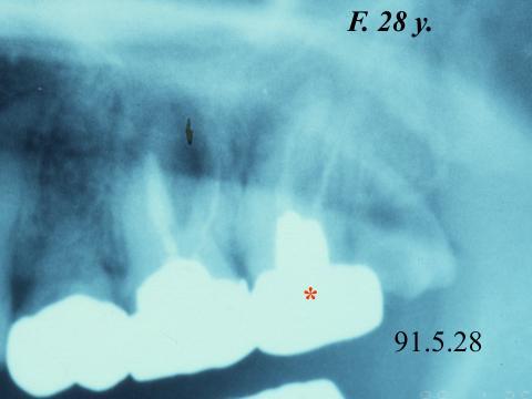 Figure 7 Left: Extracted second molar is covered with the periodontal ligament