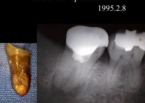 Figure 10Twelve-one years later, slight ankylosis but no sign of root