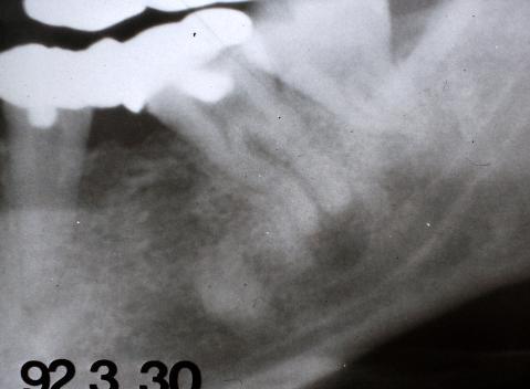 The root is curved and the root canal is obliterated in the  Figure 12Four