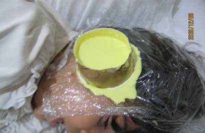 Alginate being used to create negative impression of donor ear Sculpting technique The