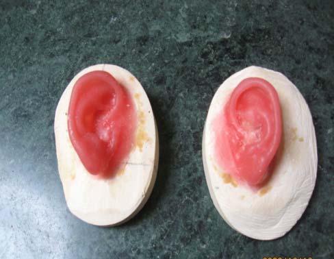 For the left ear, approximately 20 percent of the plaster base was modified, in order