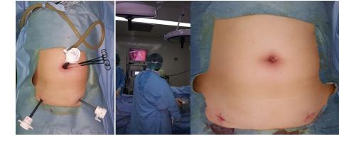 In this article, the author present and discusses the potential benefits of surgical technique the single incision laparoscopic (SILS), why as pediatric surgeons now days need to cope with, and what