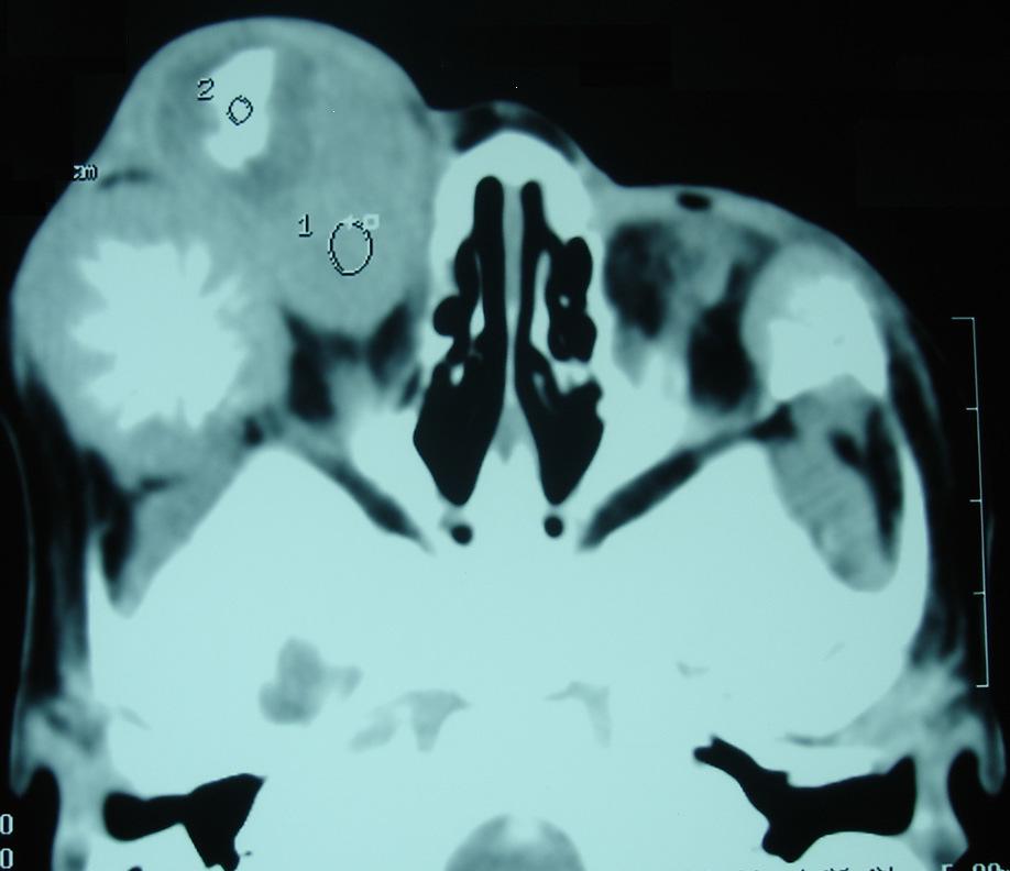 FIGURE-1: TITLE: CT Brain and Orbits (axial view) in a patient of orbital cellulites CT shows diffused